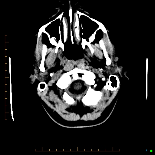File:Cerebral arteriovenous malformation (AVM) (Radiopaedia 78162-90706 Axial non-contrast 7).jpg