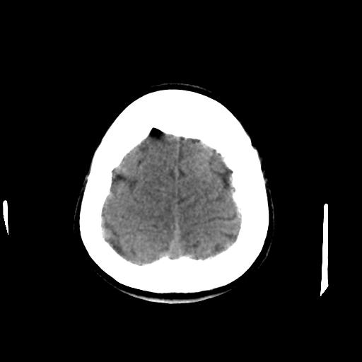Cerebral arteriovenous malformation (Radiopaedia 28518-28759 Axial non-contrast 64).jpg