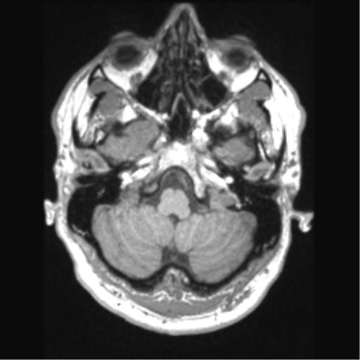 Cerebral arteriovenous malformation (Radiopaedia 39259-41506 Axial T1 16).png