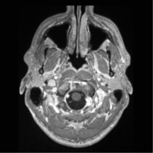 Cerebral arteriovenous malformation (Radiopaedia 55798-62372 Axial T1 C+ 3).png