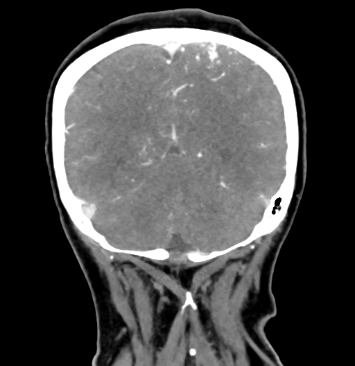 Cerebral arteriovenous malformation (Radiopaedia 73830-84645 C 75).jpg