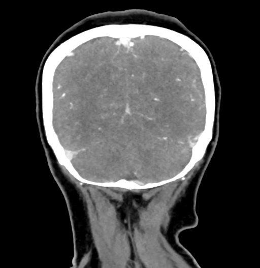 Cerebral arteriovenous malformation (Radiopaedia 73830-84645 C 79).jpg