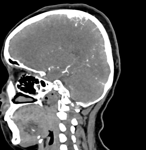 Cerebral arteriovenous malformation (Radiopaedia 73830-84645 D 56).jpg