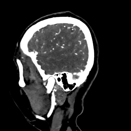 Cerebral arteriovenous malformation (Radiopaedia 73830-84645 Sagittal C+ delayed 77).jpg