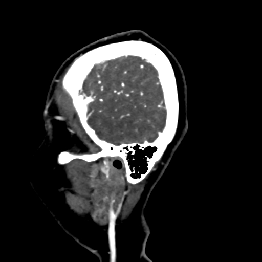 File:Cerebral arteriovenous malformation (Radiopaedia 73830-84645 Sagittal C+ delayed 82).jpg