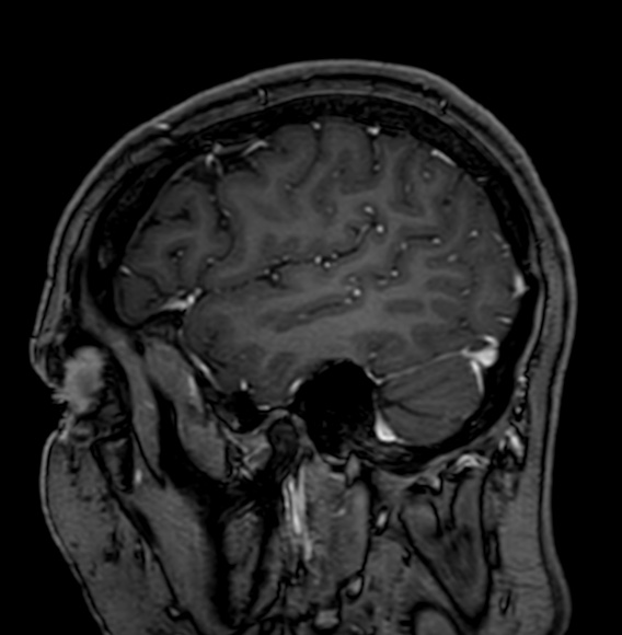 Cerebral arteriovenous malformation (Radiopaedia 74411-85746 Sagittal T1 C+ 19).jpg