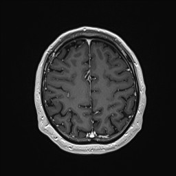Cerebral arteriovenous malformation (Radiopaedia 84015-99245 Axial T1 C+ 121).jpg