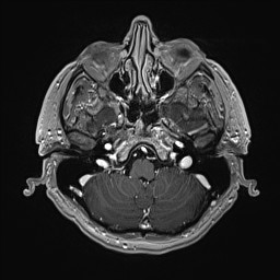Cerebral arteriovenous malformation (Radiopaedia 84015-99245 Axial T1 C+ 37).jpg