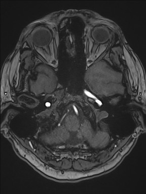 Cerebral arteriovenous malformation (Radiopaedia 84015-99245 Axial TOF 65).jpg