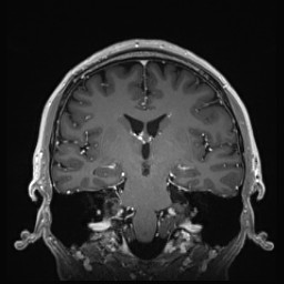 Cerebral arteriovenous malformation (Radiopaedia 84015-99245 Coronal T1 C+ 84).jpg