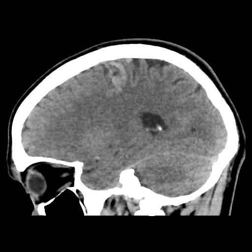 Cerebral arteriovenous malformation (Spetzler-Martin grade 2) (Radiopaedia 41262-44076 A 25).png