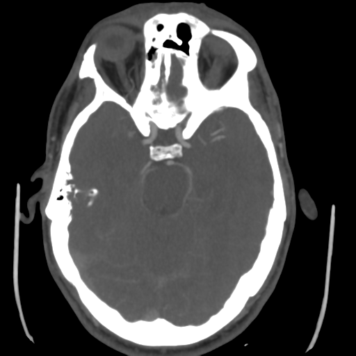 Cerebral arteriovenous malformation (Spetzler-Martin grade 2) (Radiopaedia 41262-44076 E 20).png