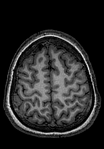 Cerebral arteriovenous malformation at posterior body of corpus callosum (Radiopaedia 74111-84925 Axial T1 43).jpg