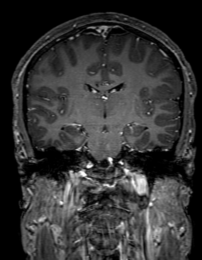 Cerebral arteriovenous malformation at posterior body of corpus callosum (Radiopaedia 74111-84925 K 194).jpg