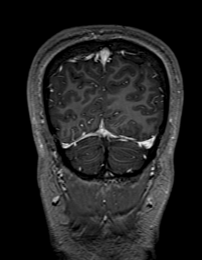 Cerebral arteriovenous malformation at posterior body of corpus callosum (Radiopaedia 74111-84925 K 329).jpg