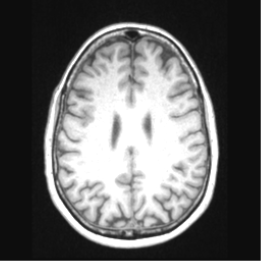 Cerebral arteriovenous malformation with hemorrhage (Radiopaedia 34422-35737 Axial T1 51).png
