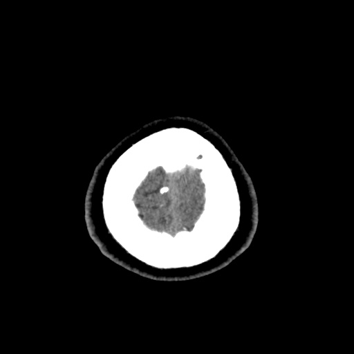 Cerebral arteriovenous malformation with lobar hemorrhage (Radiopaedia 35598-37117 Axial non-contrast 55).jpg