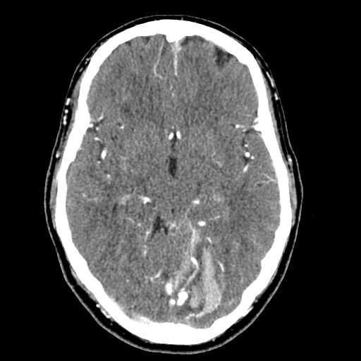 Cerebral arteriovenous malformation with lobar hemorrhage (Radiopaedia 35598-57216 A 26).jpg