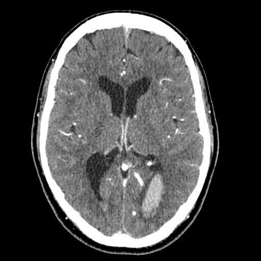 Cerebral arteriovenous malformation with lobar hemorrhage (Radiopaedia 35598-57216 A 33).jpg