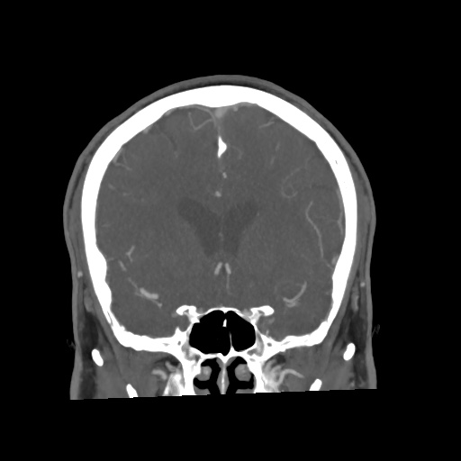Cerebral arteriovenous malformation with lobar hemorrhage (Radiopaedia 35598-57216 C 35).jpg