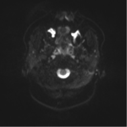 File:Cerebral cavernoma and development venous anomaly (Radiopaedia 37603-39482 Axial DWI 1).png
