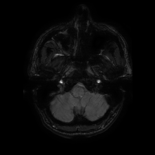 Cerebral cavernous venous malformation (Zabramski type II) (Radiopaedia 85511-101198 Axial SWI 20).jpg