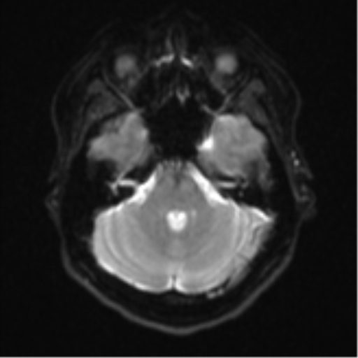 Cerebral cavernous venous malformations (Radiopaedia 48117-52946 Axial DWI 7).png