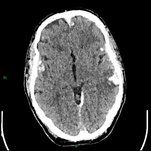 Cerebral contusions (Radiopaedia 33868-35039 Axial non-contrast 95).jpg