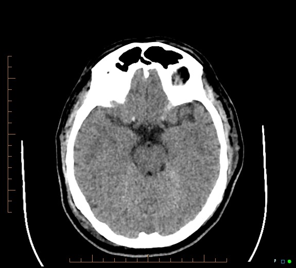 File:Cerebral fat embolism (Radiopaedia 85521-101220 Axial non-contrast 26).jpg