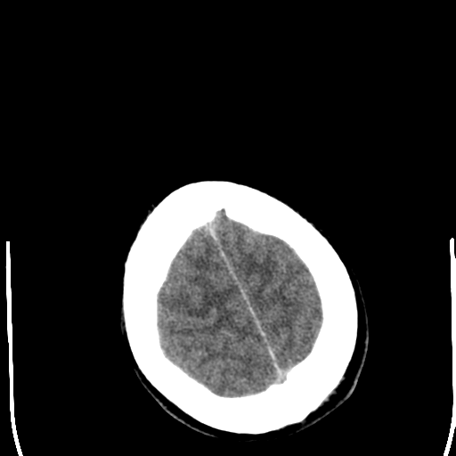 File:Cerebral hemorrhagic contusions- temporal evolution (Radiopaedia 40224-42752 Axial non-contrast 26).png