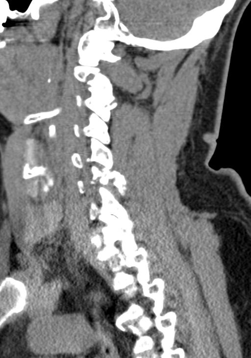 Cerebral hemorrhagic contusions and cervical spine fractures (Radiopaedia 32865-33841 G 46).jpg