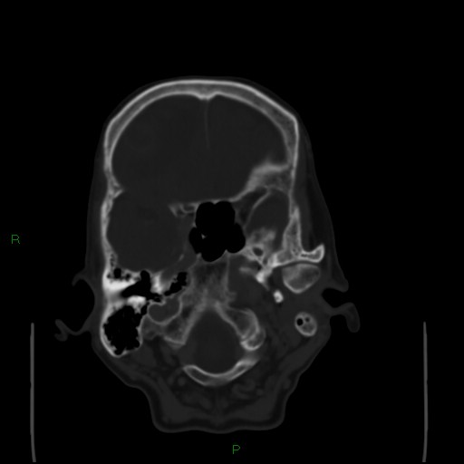 Cerebral metastases - breast primary (Radiopaedia 77653-89857 Axial bone window 24).jpg