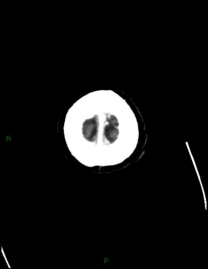 File:Cerebral metastases - ependymal and parenchymal (Radiopaedia 79877-93131 Axial C+ delayed 84).jpg