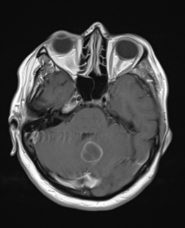 File:Cerebral metastases mimicking abscesses (Radiopaedia 45841-50131 Axial T1 C+ fat sat 9).png