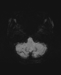 File:Cerebral metastasis (Radiopaedia 46744-51248 Axial SWI 5).png