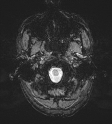Cerebral metastasis - melanoma (Radiopaedia 54718-60954 Axial SWI 3).png