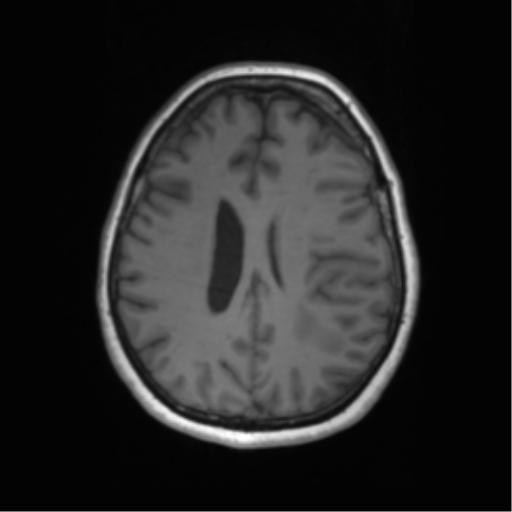 Cerebral metastasis mimicking glioblastoma (Radiopaedia 69155-78937 Axial T1 44).png