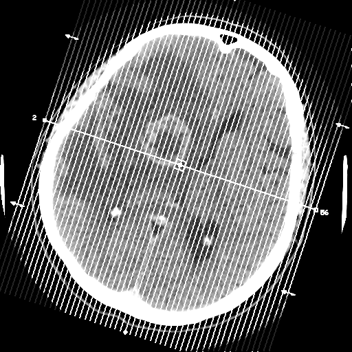 Cerebral metastasis to basal ganglia (Radiopaedia 81568-95412 Sagittal C+ delayed 1).png