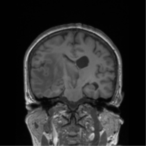 Cerebral metastasis to basal ganglia (Radiopaedia 81568-95413 Coronal T1 23).png