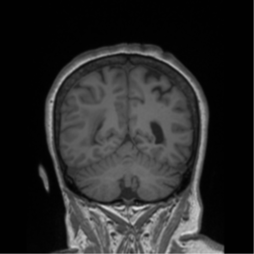 Cerebral metastasis to basal ganglia (Radiopaedia 81568-95413 Coronal T1 6).png