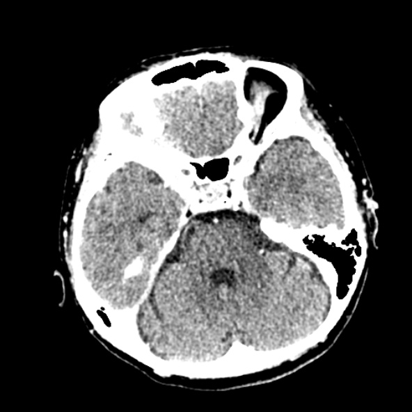 File:Cerebral ring enhancing lesions - cerebral metastases (Radiopaedia 44922-48818 B 93).jpg