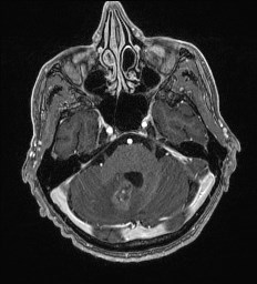 Cerebral toxoplasmosis (Radiopaedia 43956-47461 Axial T1 C+ 18).jpg