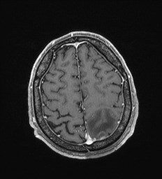 Cerebral toxoplasmosis (Radiopaedia 43956-47461 Axial T1 C+ 63).jpg