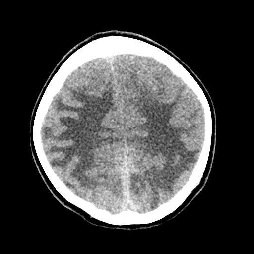 Cerebral tuberculosis with dural sinus invasion (Radiopaedia 60353-68018 Axial non-contrast 46).jpg