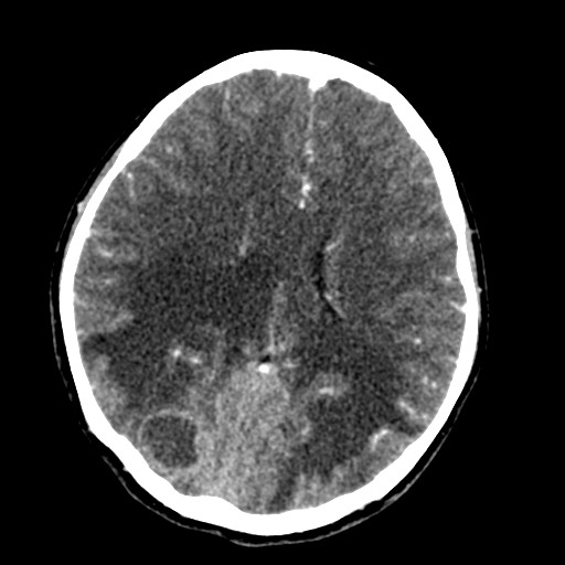 Cerebral tuberculosis with dural sinus invasion (Radiopaedia 60353-68019 Axial C+ delayed 39).jpg