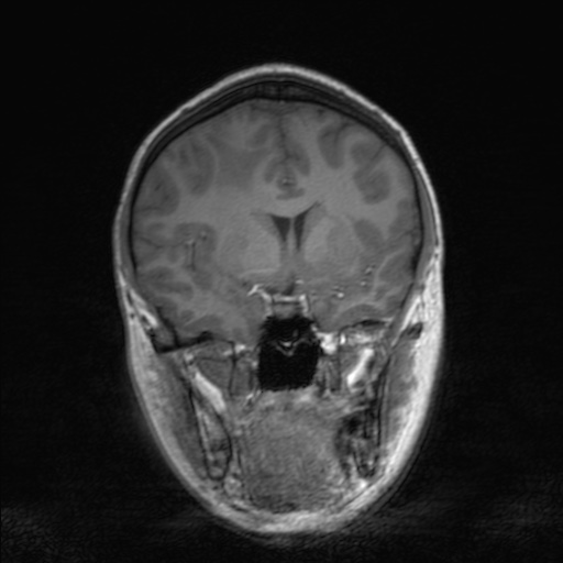 File:Cerebral tuberculosis with dural sinus invasion (Radiopaedia 60353-68090 Coronal T1 80).jpg