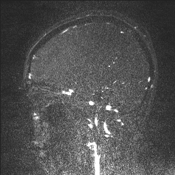 Cerebral tuberculosis with dural sinus invasion (Radiopaedia 60353-68090 Sagittal MRV 49).jpg