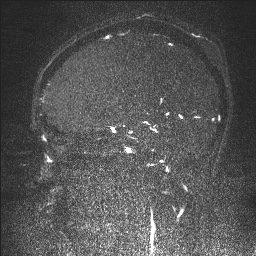 Cerebral tuberculosis with dural sinus invasion (Radiopaedia 60353-68090 Sagittal MRV 60).jpg