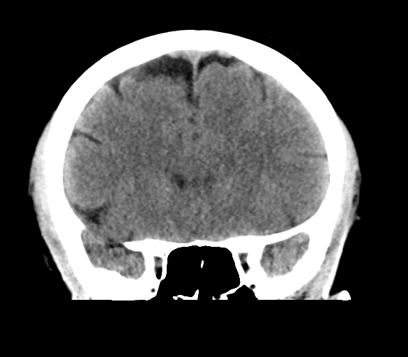 File:Cerebral venous infarction due to transverse sinus thrombosis (Radiopaedia 34688-36116 Coronal non-contrast 14).png