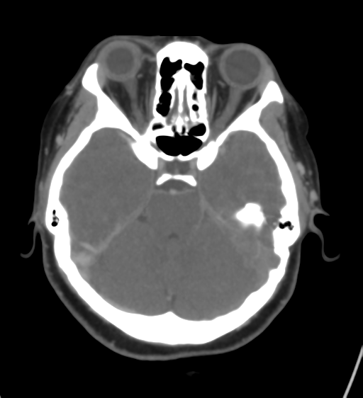 Cerebral venous infarction due to transverse sinus thrombosis (Radiopaedia 34688-36120 Axial CT venogram 18).png